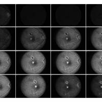 Series of time lapse photos of a Fluorescein Angiogram of right eye