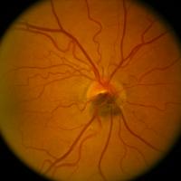 A microscopic image of a nevus on an optic nerve of the right eye 